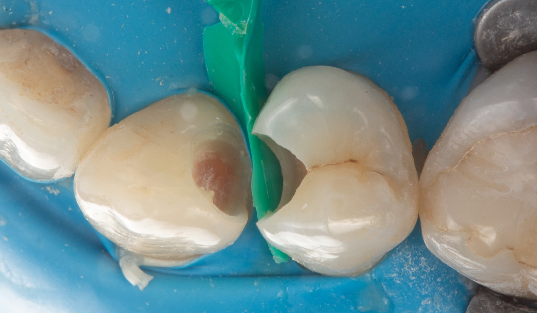 Fig. 4: Custom wedge placed to elevate the margin